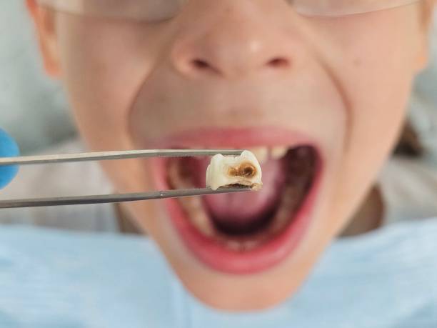 Best Knocked-Out Tooth (Avulsed Tooth) Treatment in Bryans Road, MD